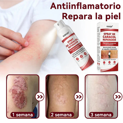 KUBOZN® 🎉SPRAY DE CADACOL REPARADOR  Para piel con psoriasis, con picazón y descamación🚑